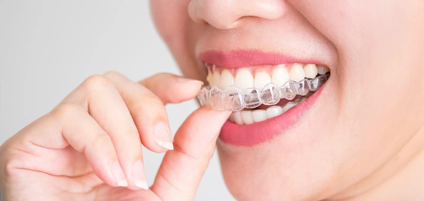 Invisalign Aligner Bornheim