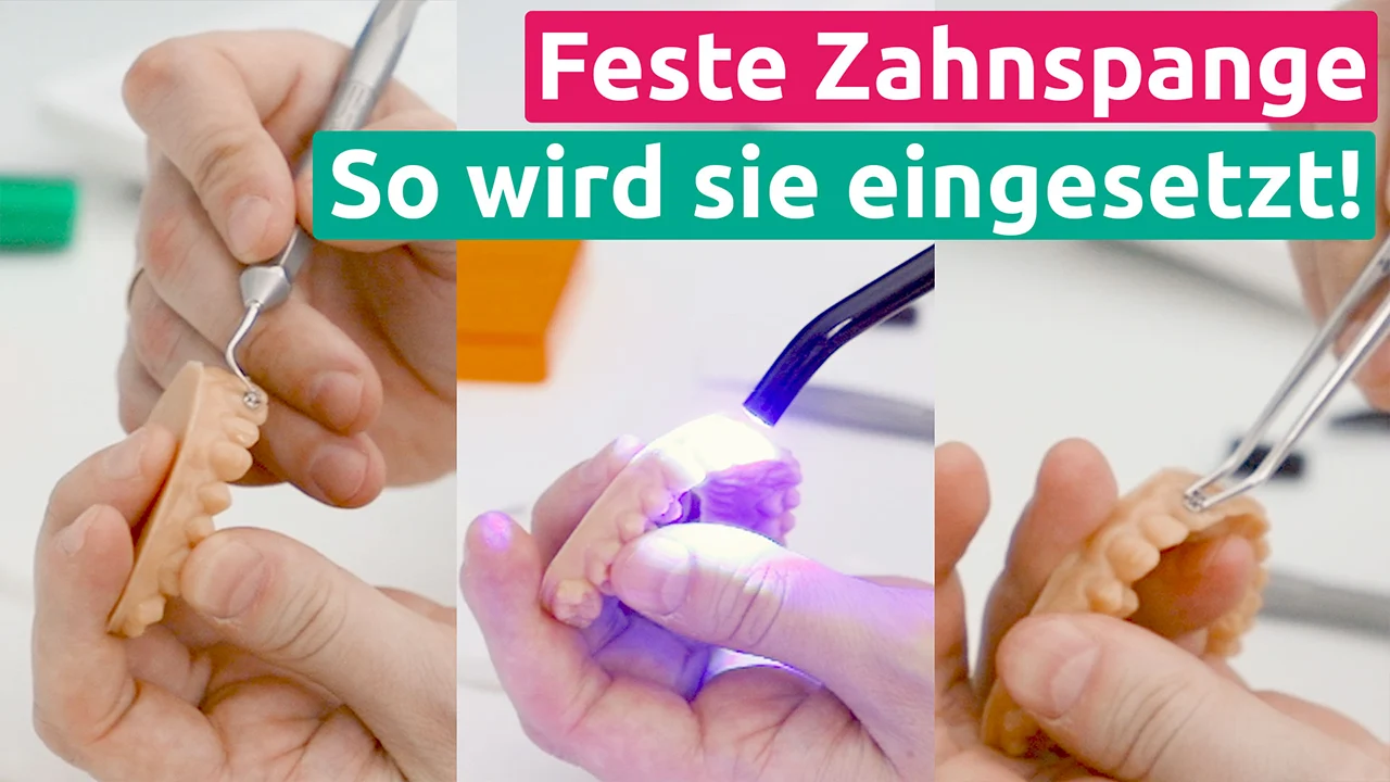 Befestigung feste Zahnspange Zahn