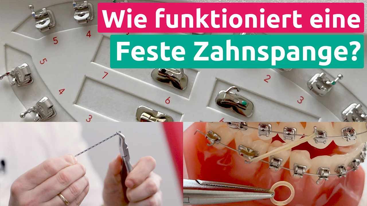 Funktionsweise feste Zahnspange